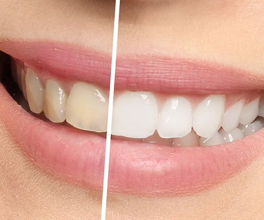 Bleaching Dr. Andre Müller Zahnarzt in Leutenbach-Nellmersbach Bleaching Dr. Andre Müller Zahnarzt in Leutenbach-Nellmersbach