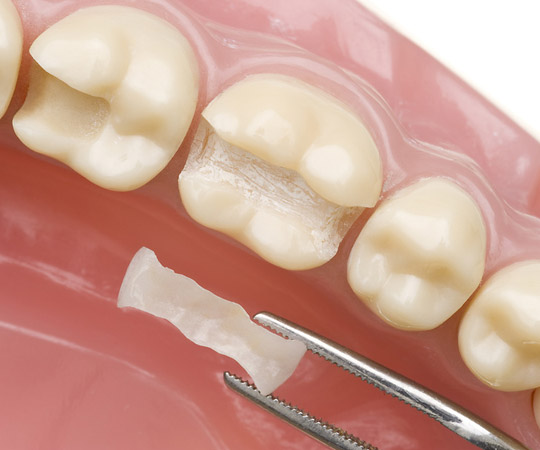 Inlay Dr. Andre Müller Zahnarzt in Leutenbach-Nellmersbach Inlay Dr. Andre Müller Zahnarzt in Leutenbach-Nellmersbach