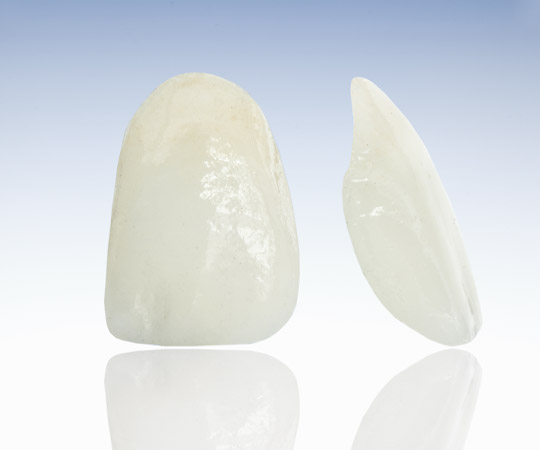 Veneers Dr. Andre Müller Zahnarzt in Leutenbach-Nellmersbach Veneers Dr. Andre Müller Zahnarzt in Leutenbach-Nellmersbach